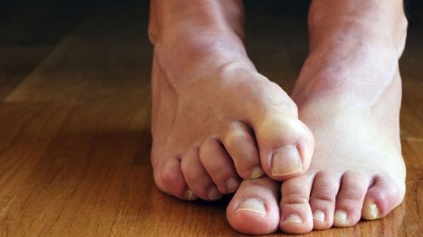 5 Natural Ways For Permanent Relief of Athlete’s Foot - Healthy Living ...