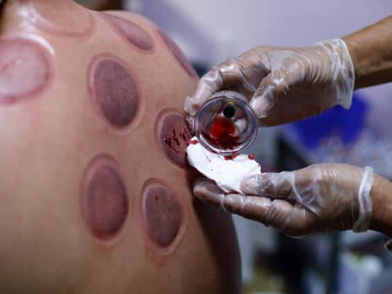 bleeding while cupping