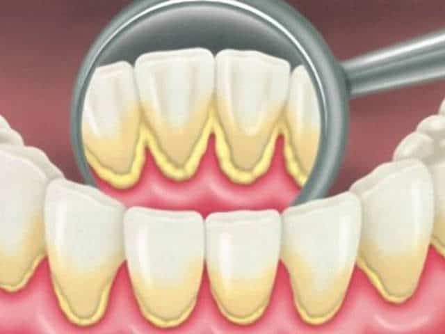 dental plaque