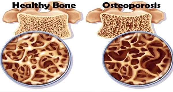 bone with osteoporosis