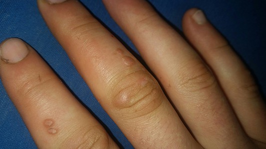 Warts on the hand