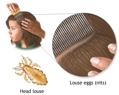 Naturally Treat Head Lice - Healthy Living Daily