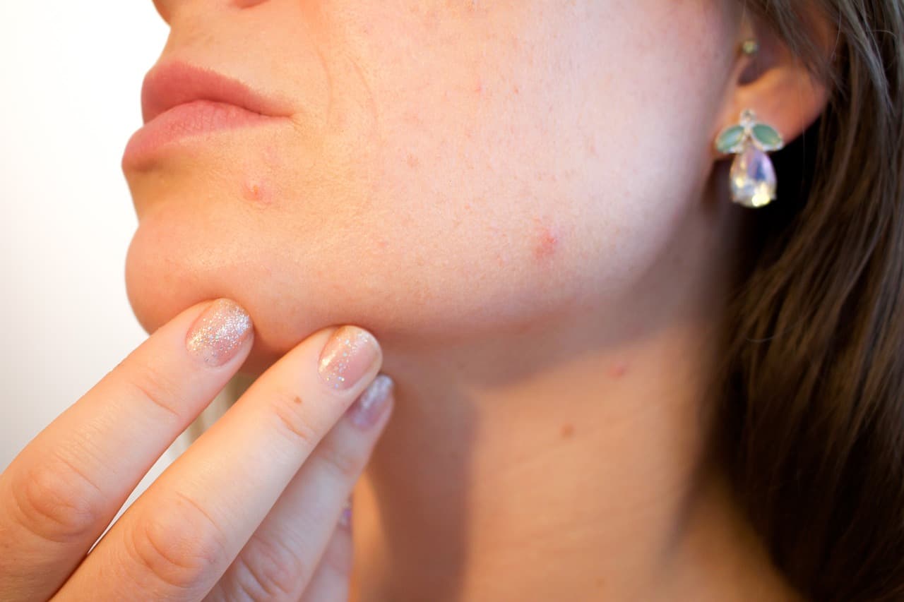 woman with acne problem