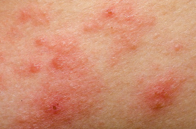 eczema - a skin irritation