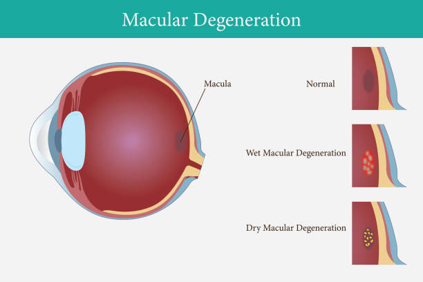 Age-related macular degeneration.Eye vision disorder.
