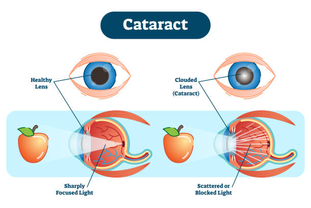 Cataract vector illustration diagram, anatomical scheme. A cataract is a clouding of the lens in the eye which leads to a decrease in vision.