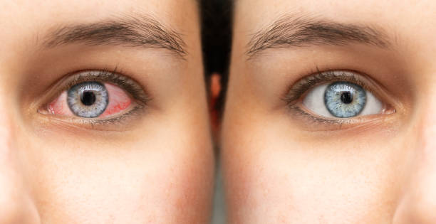 Comparing of eye before and after eyedrop treatment. Female red irritated and healthy eye closeup. Mirroring view. Healthcare and eyecare concept.