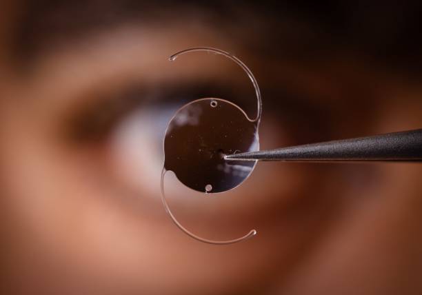 Close-up of an intraocular lens being held by tweezers with a blurred eye in the background.