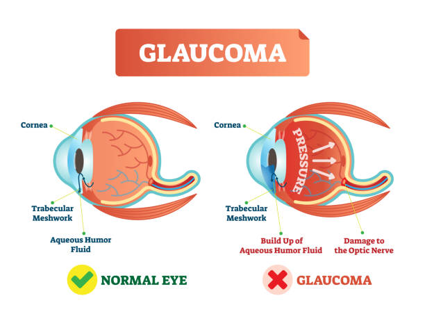 Glaucoma illness vector illustration. Cross section close-up comparement with normal and damaged eye. Scheme with cornea, trabecular meshwork, aqueous humor fluid, pressure and optic nerve damage.